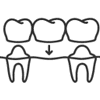 Two teeth supporting a dental bridge with three crowns in a dental office setting.
