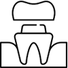 Dental crown illustration showing tooth structure with cap placement and support components.
