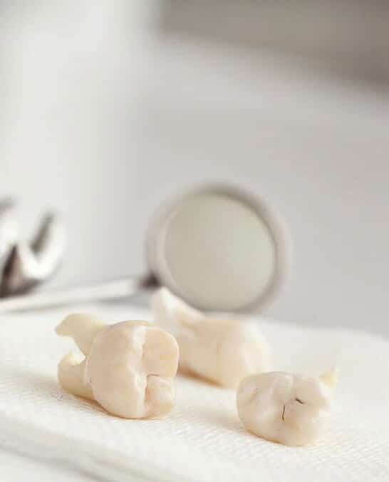 Extracted teeth on a dental napkin with mirror — professional tooth extraction procedure