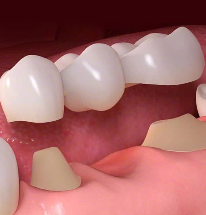 Dental bridge restoration showing three connected porcelain crowns replacing missing teeth on gum model.