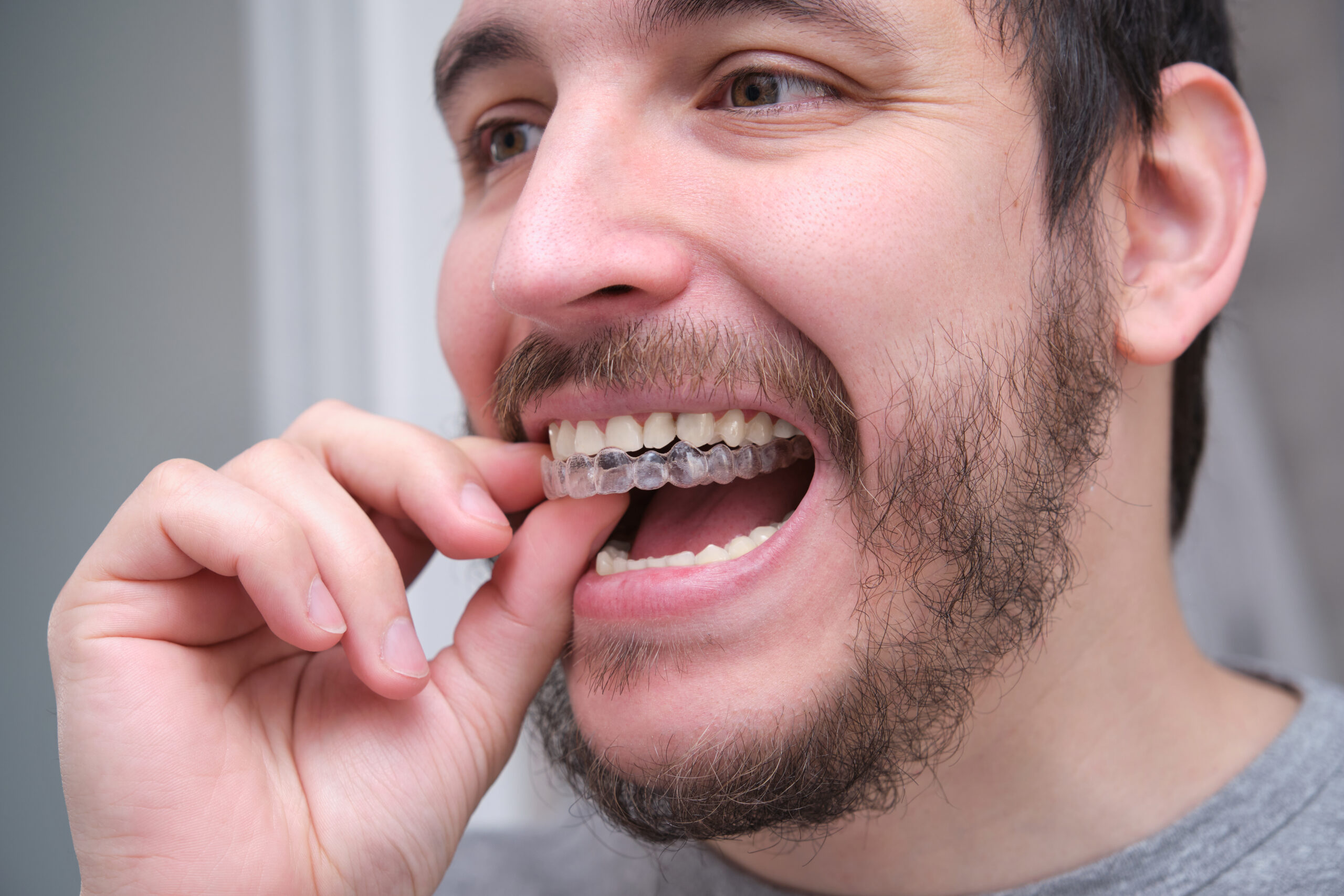 A Smile Makeover Journey with Invisalign in Poway