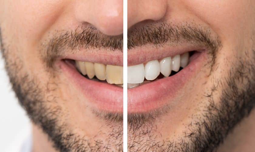 Before and after comparison of teeth whitening results showing yellowed versus bright white teeth.