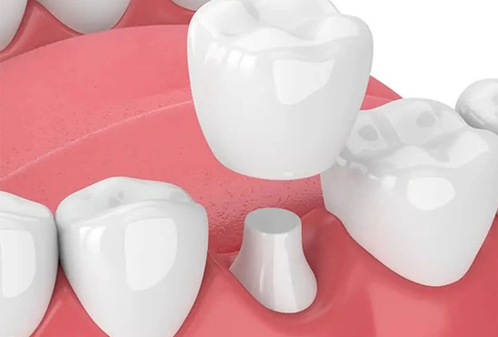 Dental Crown image