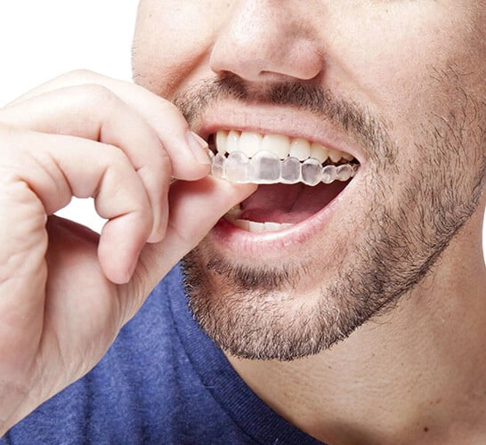 Patient using Invisalign clear aligners — discreet orthodontic solution for a straighter smile