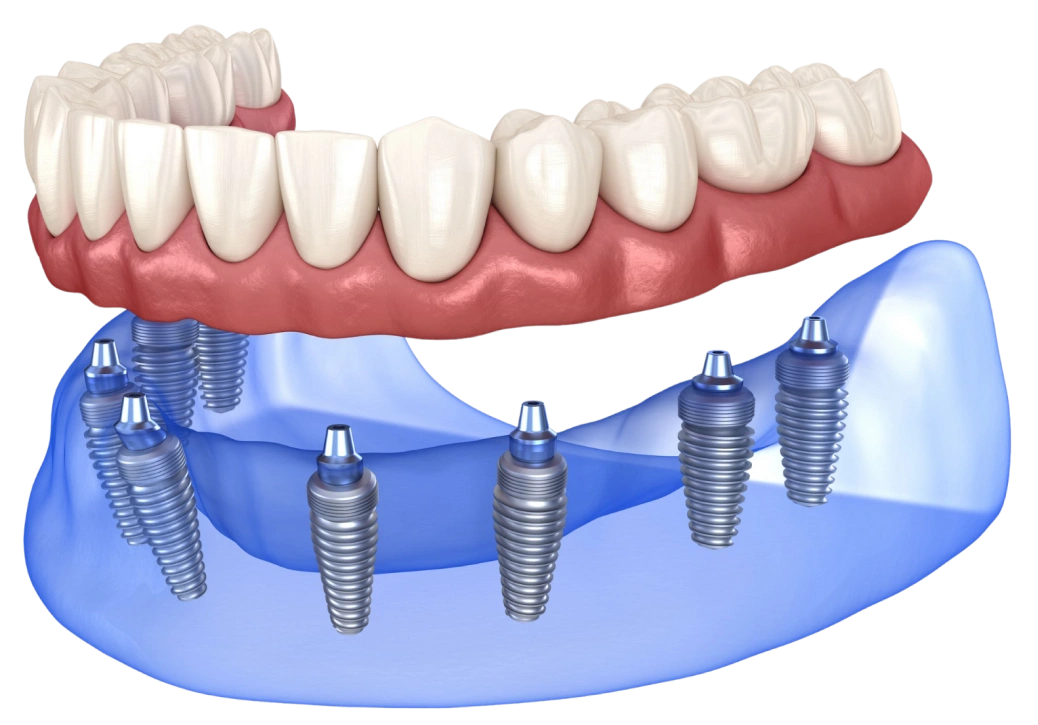 Dental implants illustration showing prosthetic teeth secured to jawbone anchors