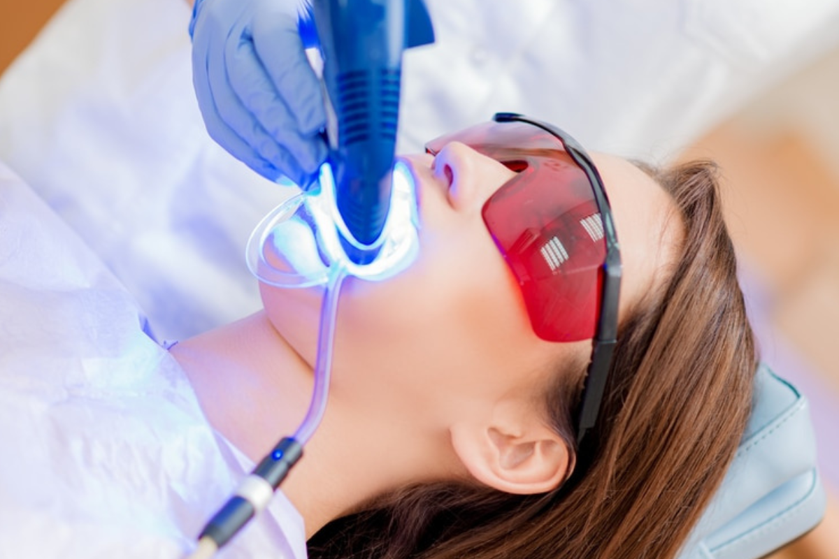 How Often Should You Whiten Your Teeth?