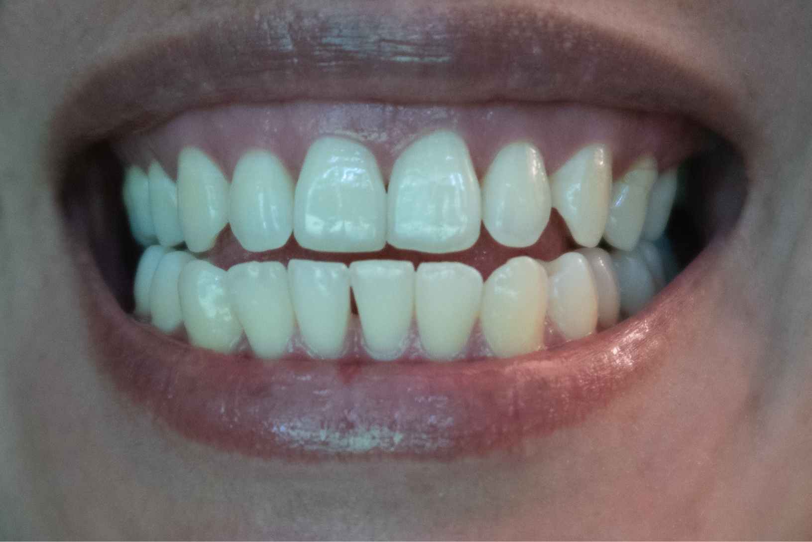 Close-up of a patient's smile showing bright white teeth with proper alignment and spacing after dental treatment.